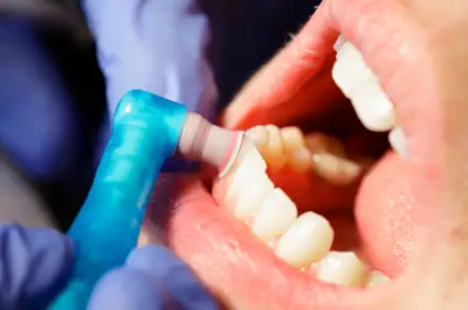 Mechanical polisher cleaning used to clean a patient's teeth at East Portland Dentistry in Portland, OR