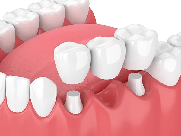 3D rendering of a dental bridge being placed over a missing tooth gap that is flanked by two shaved down teeth at East Portland Dentistry in Portland, OR