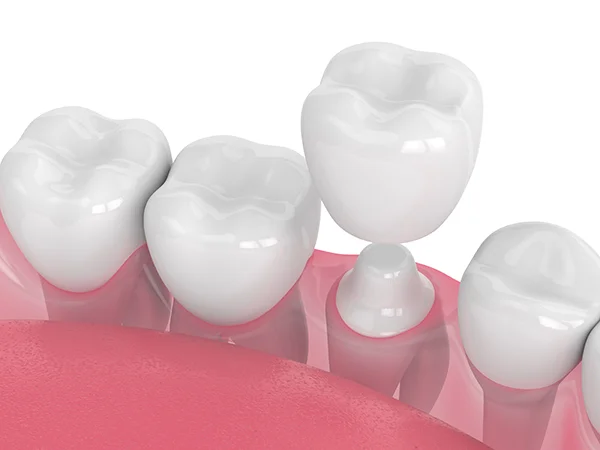 Close up 3D rendering of a dental crown being placed on a shaved down tooth at East Portland Dentistry in Portland, OR