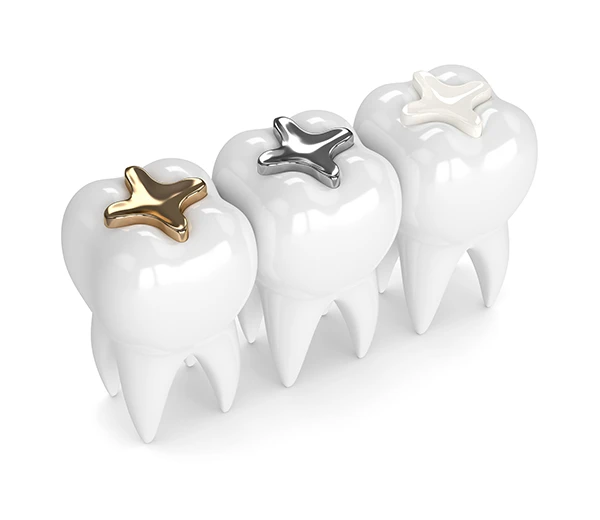 3D rendering of three teeth each with a different dental filling material: composite, amalgam, and gold at East Portland Dentistry in Portland, OR