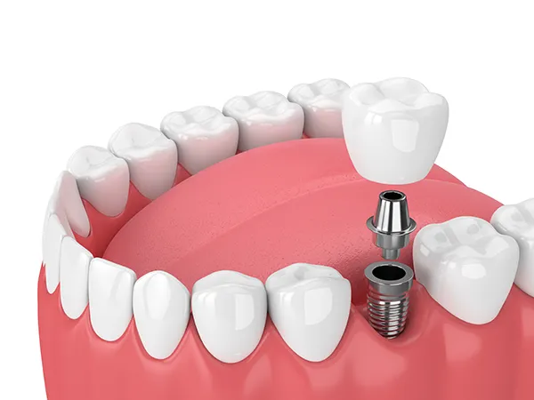 3D rendering of a dental implant and its components (screw, abutment, and crown) being placed into the jaw at East Portland Dentistry in Portland, OR