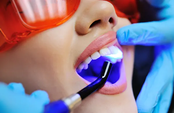 Close up of a dental assistant applying a UV light to a female patient's newly sealed teeth at East Portland Dentistry in Portland, OR