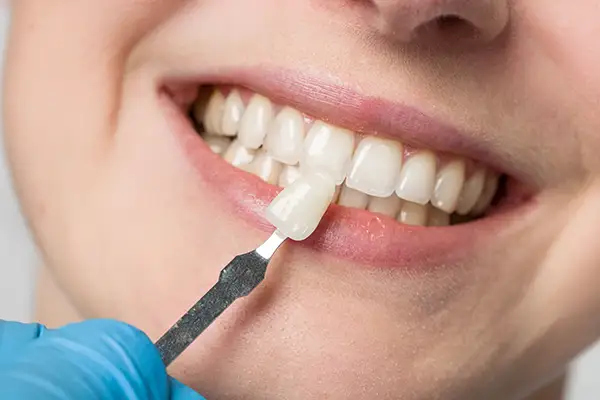 Dentist using a precise shade matching tool to select the ideal dental veneer for a smiling patient's teeth.